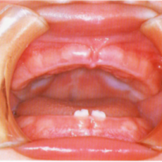 生後6ヶ月から1歳頃に生える上下乳前歯とは？赤ちゃんの虫歯予防2回