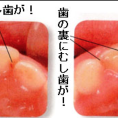 「1歳児頃の乳前歯の歯並びと虫歯の関係」赤ちゃんの虫歯予防4回