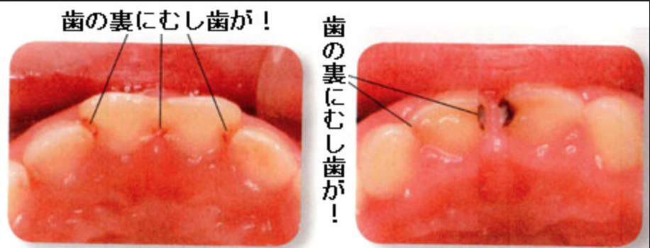 「1歳児頃の乳前歯の歯並びと虫歯の関係」赤ちゃんの虫歯予防4回