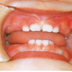 「赤ちゃんの前歯のむし歯の判断と歯並び!」赤ちゃんの虫歯予防3回