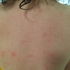 赤ちゃん子どものお肌のトラブルどうしてる?オムツかぶれ、スキンケア