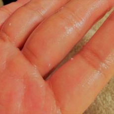 授乳中のおっぱいトラブル① ―白斑白いカス・にきび・乳腺炎―母乳育児第5回